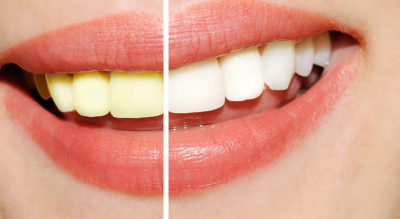 Does Coconut Oil and Turmeric Teeth Whitening Really Work? Five&hellip;