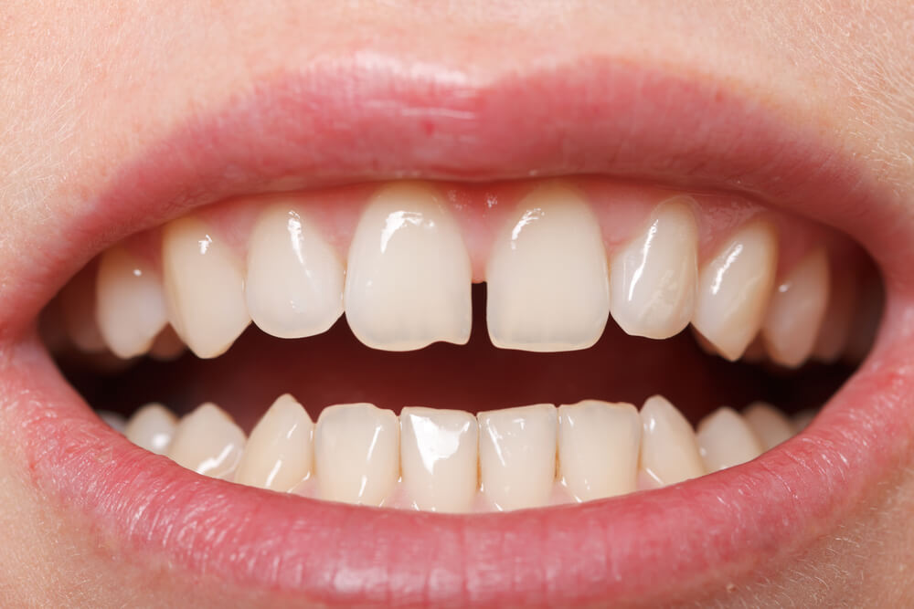 Are Teeth Gap Bands Safe?